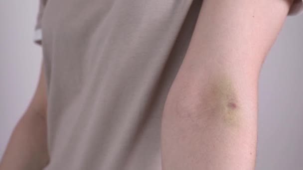 Close Vrouwelijke Persoon Hand Met Hematoom Kneuzing Injectie Bloed Bemonstering — Stockvideo