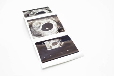 6 haftalık hamile kadın cenininin ultrason fotoğrafı, beyaz arka planda embriyo resmi. Seçici Odaklanma. Fetüs gelişimi, Hamilelik Sağlık Kontrolü. Doğum, Yatay Düzlem