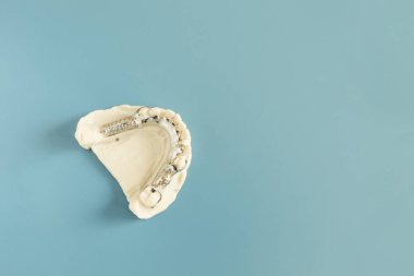 Mockup Metal Frame Lower Partial Protez, Plate On Die Stone, Alçı kalıp of Lower Jaws, Cobalt Chrome diş plakası, Düz Yastık Mockup 3D Baskı Köprüsü Mavi Arkaplan. Uzayı kopyala Yatay.