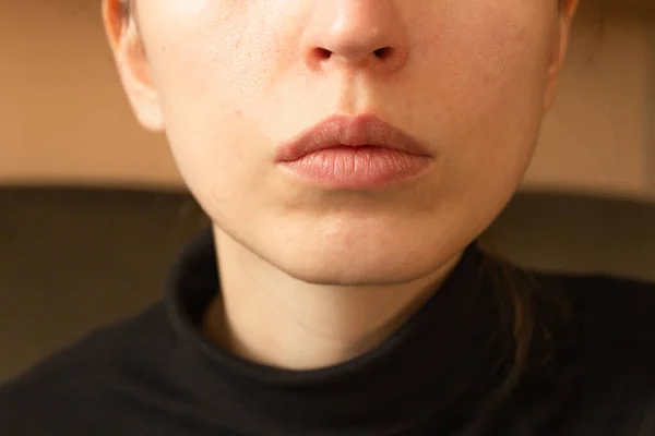 Les Lèvres Jeune Femme Infectaient Virus Herpès Regard Indolore Sans Photo De Stock