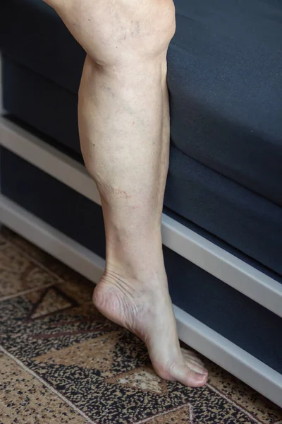 Starsza Kobieta Pokazuje Gołą Nogę Stopę Zapaleniem Żył Żylnych Żyłami — Zdjęcie stockowe