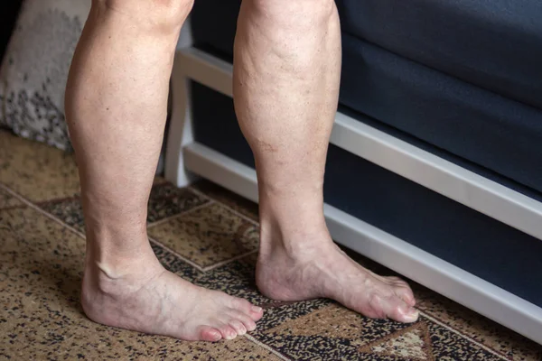 シニア女性は 静脈瘤の炎症やクモの静脈で彼女の裸の足や足を示しています 祖母は部屋の床に足を踏み入れる 時代の変化と医療の概念 — ストック写真