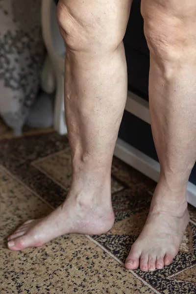 シニア女性は 静脈瘤の炎症やクモの静脈で彼女の裸の足や足を示しています 祖母は部屋の床に足を踏み入れる 時代の変化と医療の概念 — ストック写真