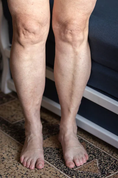 Ανώτερη Γυναίκα Δείχνουν Γυμνά Πόδια Και Πόδια Της Κιρσούς Φλεγμονή — Φωτογραφία Αρχείου