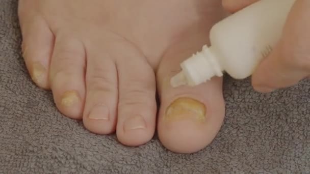 应用药物治疗脚趾甲口臭患者 后续行动 — 图库视频影像