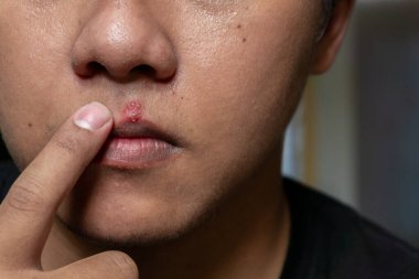 Erkek dudakları uçuk kabarcıklarını etkiledi. Herpes virüsü ve enfeksiyon tedavisi