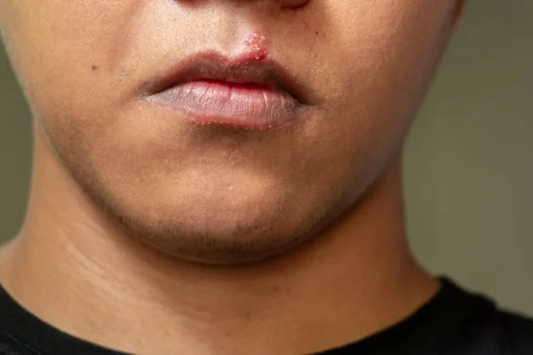 Men lips affected herpes blisters. Herpes virus and infection treatment