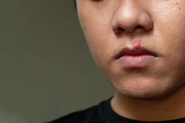 Men lips affected herpes blisters. Herpes virus and infection treatment