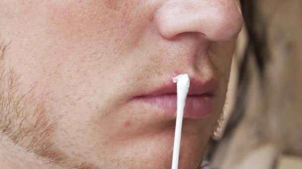 クローズアップ若い男の唇に 綿棒の上のヘルペスは 男の唇に傷に軟膏を適用します ハープクリーム — ストック動画
