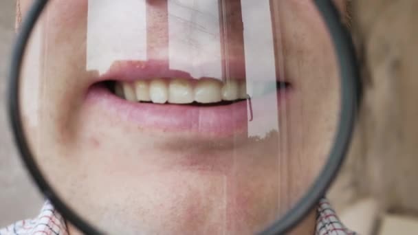 Dents Masculines Travers Une Loupe Caries Dentaires Herpès Sur Lèvre — Video