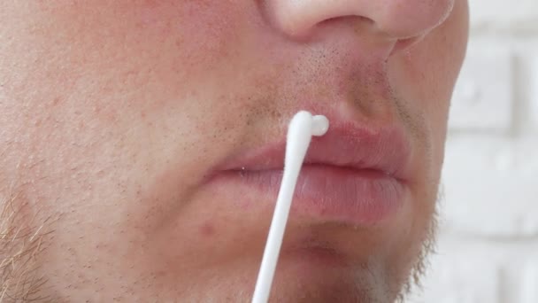 一个年轻人嘴唇上的疱疹 在他嘴唇上的伤口上涂上药膏 疱疹膏 — 图库视频影像