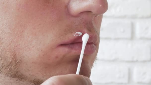 若い男の唇にヘルペス 綿棒上 男の唇に傷に軟膏を適用します ハープクリーム — ストック動画