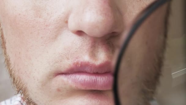 クローズアップ拡大鏡を通して男の唇にヘルペス 唇ににきび ヒトにおけるウイルス性ヘルペス 若い男は ウイルス性疾患のヘルペスを示しています — ストック動画