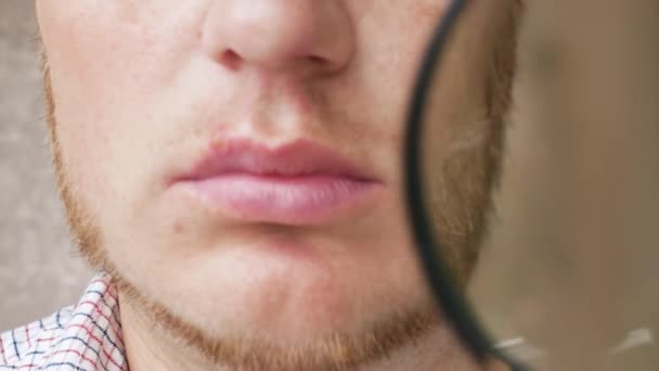 通过放大镜在男人唇上贴上特写疱疹 唇上贴上粉刺 嘴唇上的人有病毒性疱疹 — 图库视频影像
