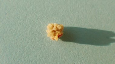 Makro yakın planda bir insan böbreğinden taş fırlatıyor, cetvelle taşın boyutunu ölçüyor. Bir insan böbreğinden fosfat ya da urat kalkülüsü.