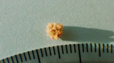 Makro yakın planda bir insan böbreğinden oksalat taşı çıkartıyor. Cetvelle taşın boyutunu ölçüyor. İnsan böbreğinden fosfat ya da urat hesabı.