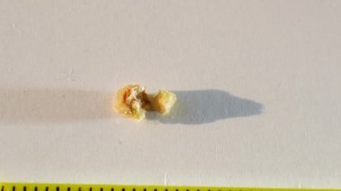  İnsan böbreğinden çıkarılan bir taş, cetvelle taşın büyüklüğünü ölçer. İnsan böbreğinde fosfat veya ürat hesabı 4 mm