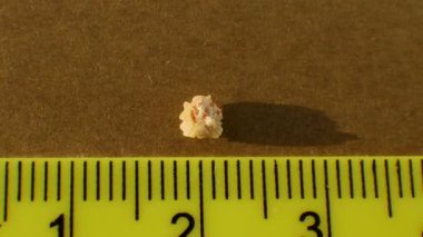 Yakın planda bir insan böbreğinden çıkan oksalat taşı, cetvelle taşın boyutunu ölçer. Fosfat ya da kalkülüs insan böbreğinde 4 mm. Böbrek taşının incelenmesi