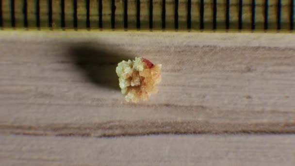 草酸肾结石4毫米 肾结石从肾结石上移开 肾结石闭锁 人肾中形成的天然石材 — 图库视频影像