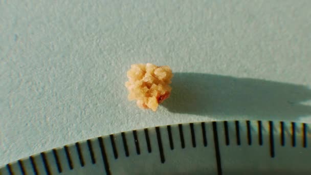 Macro Shooting Oxalate Stone Human Kidney Close Measuring Size Stone — Stock Video