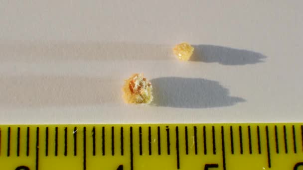 Macro Video Frame Stone Removed Human Kidney Measuring Size Stone — Stock Video