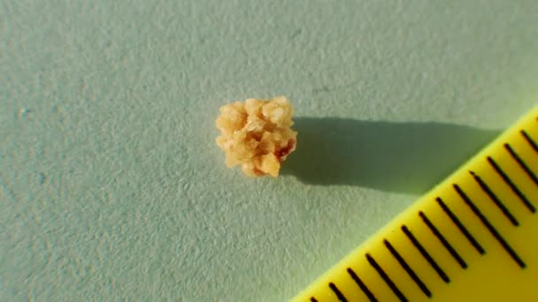 Macro Shooting Oxalate Stones Human Kidney Close Measure Size Stone — Stock Video