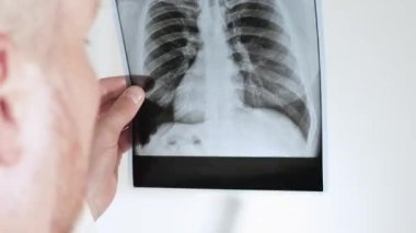 Radyolog - bir uzman beyaz arka planda bir insanın akciğerlerinin röntgenini analiz eder. Akciğer zatürresi. Resimde türbeküloz