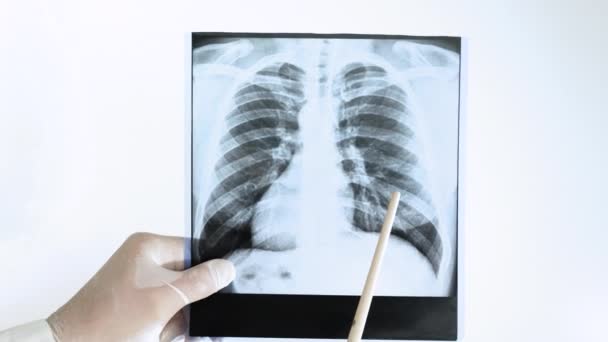 結核は人間の肺のX線で 医師は白い背景に肺のX線を分析します — ストック動画