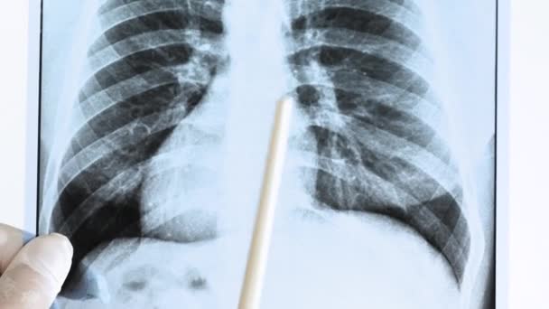 Κοντινό Πλάνο Φυματίωση Ανθρώπινη Πνευμονική Ακτινογραφία Γιατρός Αναλύει Μια Ακτινογραφία — Αρχείο Βίντεο