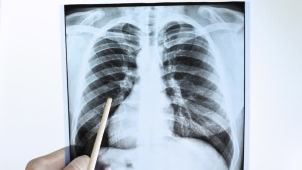 Radiólogo Especialista Analiza Una Radiografía Los Pulmones Una Persona Sobre — Vídeo de stock