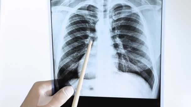 放射線科医 専門家は白い背景に人の肺のX線を分析します ポインタを持つ医師は 男の肺疾患を示しています 肺の肺炎 結核だよ — ストック動画