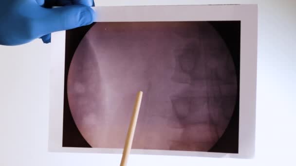 Röntgenbild Einer Niere Mit Einem Stein — Stockvideo