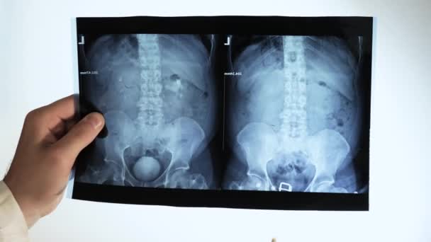 一位经验丰富的医生对肾部进行了X光检查 对有白色背景石头的肾部进行了X光检查 医生分析草酸肾结石 — 图库视频影像