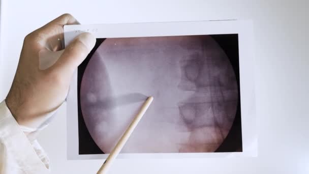 Röntgenbild Einer Niere Mit Einem Stein Ein Arzt Analysiert Einen — Stockvideo