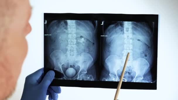 一位经验丰富的医生仔细检查了用石头做的肾部X光检查 医院的医生在X光片上的一块草酸石显示了人体肾X光片的指针 — 图库视频影像