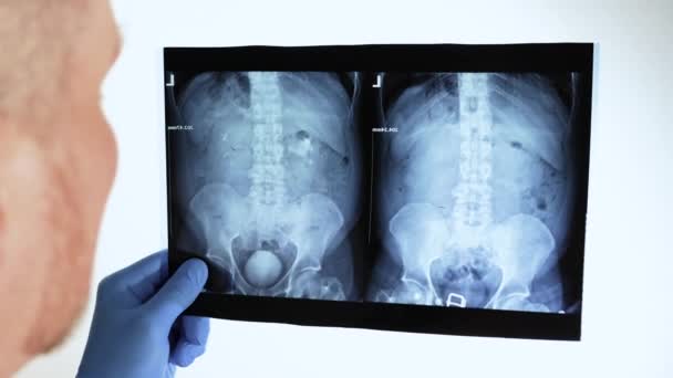 Médico Examina Cuidadosamente Radiografía Del Riñón Con Cálculo Piedra Oxalato — Vídeos de Stock