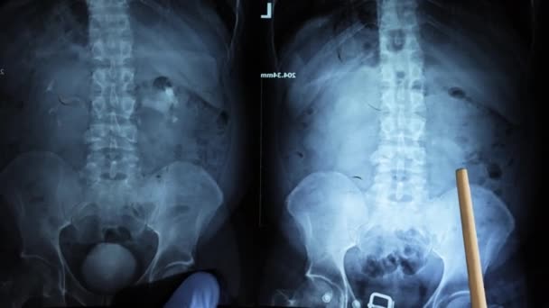 Medico Esperto Guarda Attentamente Una Radiografia Rene Con Calcolo Pietra — Video Stock