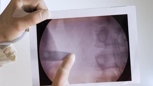 白い背景に石を持つ腎臓のX線 医師はオキサレート腎臓結石を分析し — ストック動画