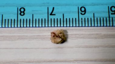 İnsan böbrek taşı yakın plan. İnsan böbreğinden çıkarılan oksalat taşı. 5 mm.
