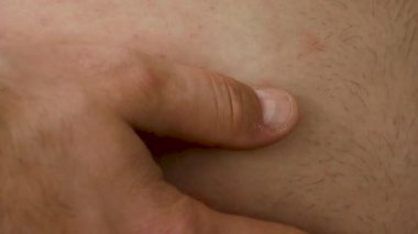 Derinin alerjik bölgesi. Ciltte alerjik kızarıklık var. İnsanlarda alerji hastalığı. Bir adamın derisinde kırmızı lekeler. Muechina 'da karın derisi hastalığı.