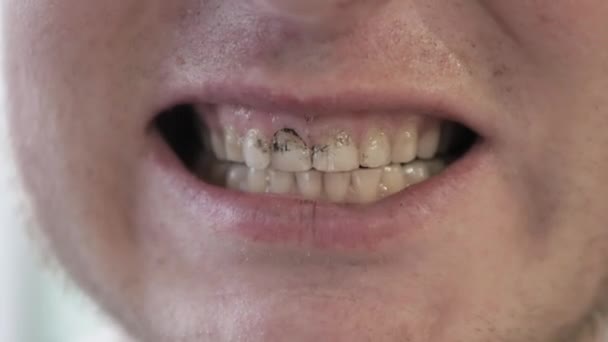 Miękki Skupienie Uśmiechnięty Człowiek Brudnymi Zębami Facet Pokazuje Brudne Zęby — Wideo stockowe