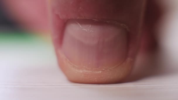 Nahaufnahme Eines Menschlichen Fingernagels Die Haut Ist Beschädigt Peeling Der — Stockvideo