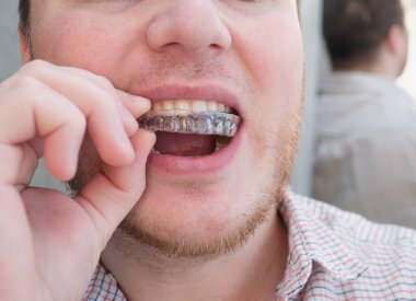 A man demonstrates putting on a plastic aligner plate from brcusism, a cap for aligning teeth or an aligner. The concept of healthy teeth in men