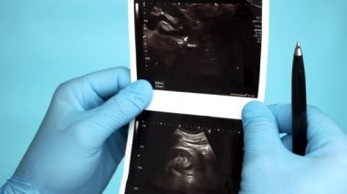 Close-up, Doctor examines in the operating room analyzes the ultrasound of a stone or calculus in the human kidney 8mm. An expert doctor examines how to remove a stone from the ureter.