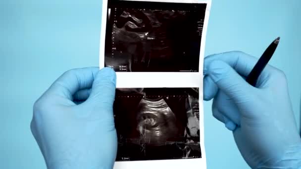 Hands Doctor Ray Human Kidney Calculus Ultrasound Medical Worker Analyzes — Vídeos de Stock