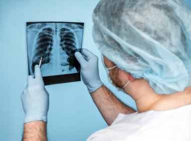 Tüberküloz. Akciğer kanseri. Üniformalı bir cerrah, röntgen çeken bir doktor, akciğerlerin röntgenini dikkatlice inceleyen bir radyolog, zatürree ve solunum hastalıklarını dikkatle inceleyen bir doktor. İnsanlarda akciğer komplikasyonu