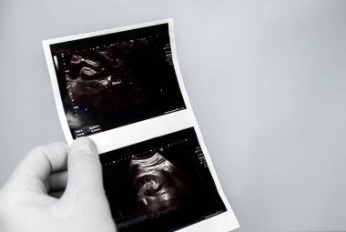 Erkek idrar yolu hastalığı. Üreterdeki kalkülüs oksalatadır. Ürolog doktor bir taş hastalığını, röntgende bir hastanın böbreğinin ultrasonunu, bir taşı ya da böbreğin kalkülüsünü doktorun elinde ultrasonda analiz eder..