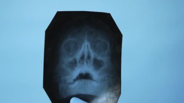 Kafatasının röntgenini çek. Klinikteki doktor bir kişinin kraniyoerebral yaralanmasına veya nazofarinkse dikkatlice teşhis koyar. İnsan burnunun röntgeni. Ofisteki doktor hastalığın teşhisini koyuyor.