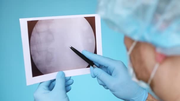 Urology Doctor Diagnosing Person Kidney Ultrasound 8Mm Oxalate Stone Stuck — Stock Video
