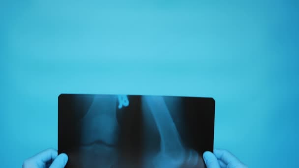 Γιατρός Διαγνώνει Ακτινογραφίες Στα Γόνατα Ενός Ατόμου Κοντινό Πλάνο Τραυματισμός — Αρχείο Βίντεο